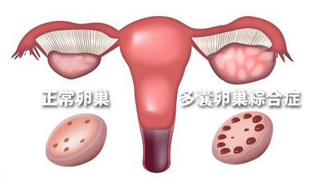 医案 | 关于多囊卵巢，你应该知道的真相！